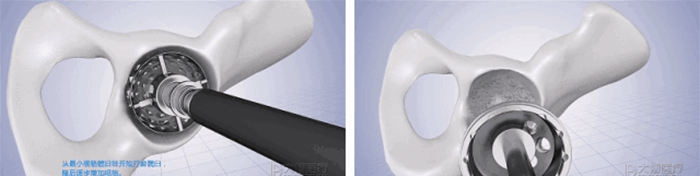 Machining, 3D Printing and Implantation Process of Acetabular Cup Machining, 3D Printing and Implantation Process of Acetabular Cup