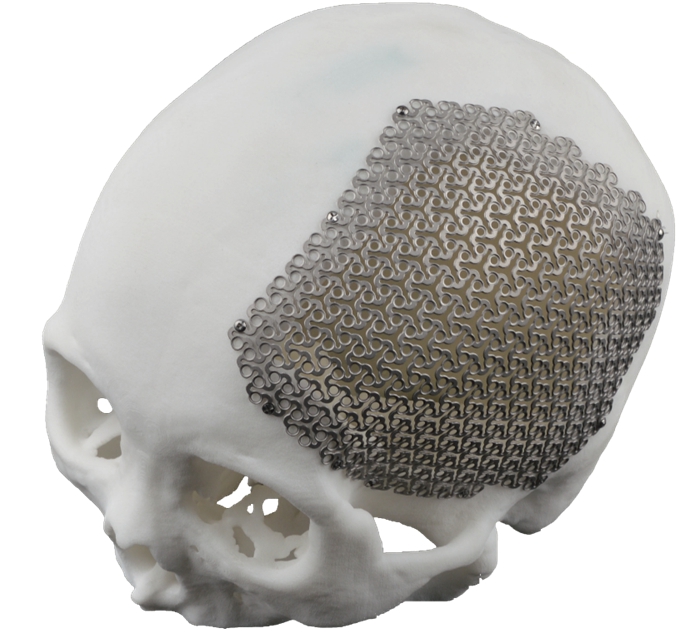 Manufacturing and Materials of 3D Printed Cranial Plates Manufacturing and Materials of 3D Printed Cranial Plates