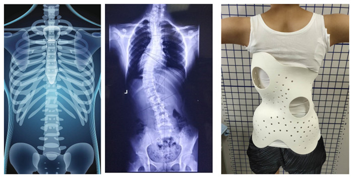 Scoliosis Orthoses - A Typical Application of SLS 3D Printing Scoliosis Orthoses - A Typical Application of SLS 3D Printing