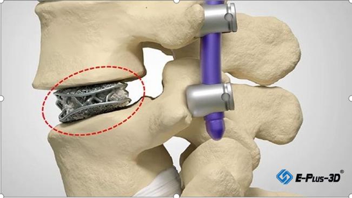 Spinal Implant Manufacturing Using EP-M250 Metal 3D Printer Spinal Implant Manufacturing Using EP-M250 Metal 3D Printer