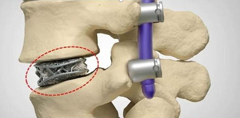 What Metal Material is More Suitable for Implants Printing?