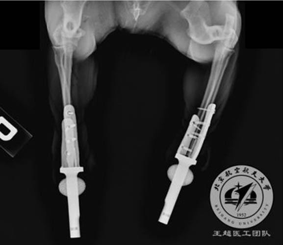 What Metal Material is More Suitable for Implants Printing?